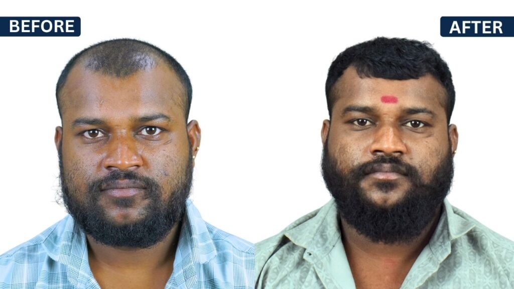 SHYAM SHINGE PRP Treatment in Pune Hair Transplant in Pune, Dr Kiran Chotaliya