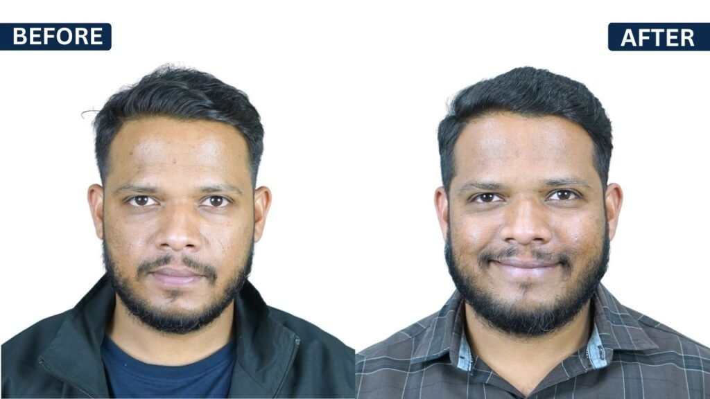 SUJIT JUNGHARE PRP Treatment in Pune Hair Transplant in Pune, Dr Kiran Chotaliya