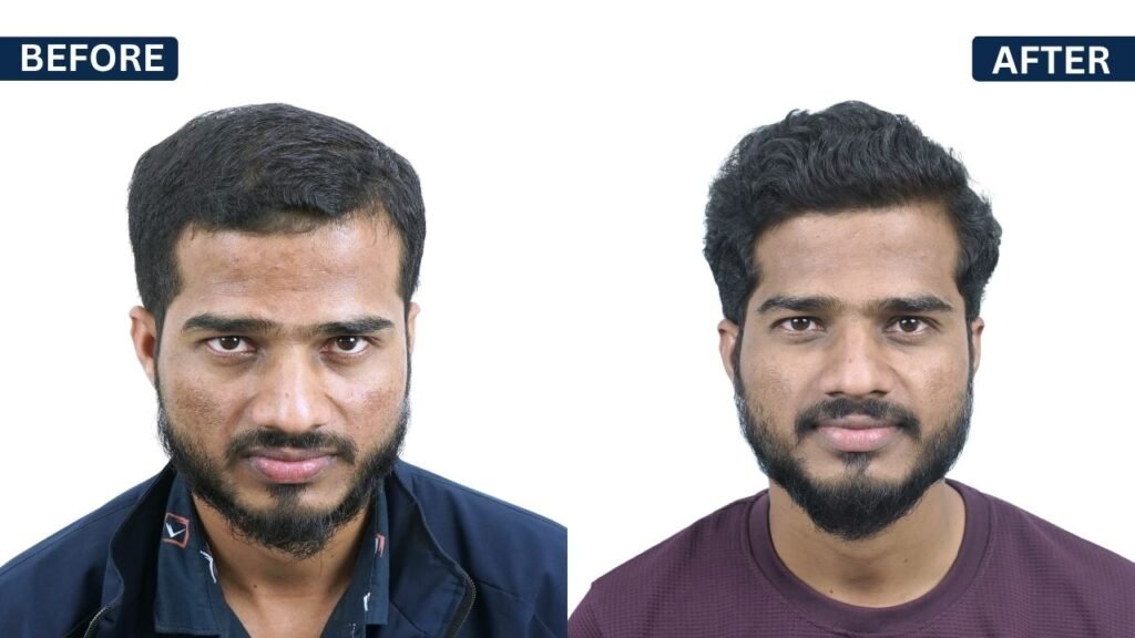 Shubham Pawar PRP Treatment in Pune Hair Transplant in Pune, Dr Kiran Chotaliya