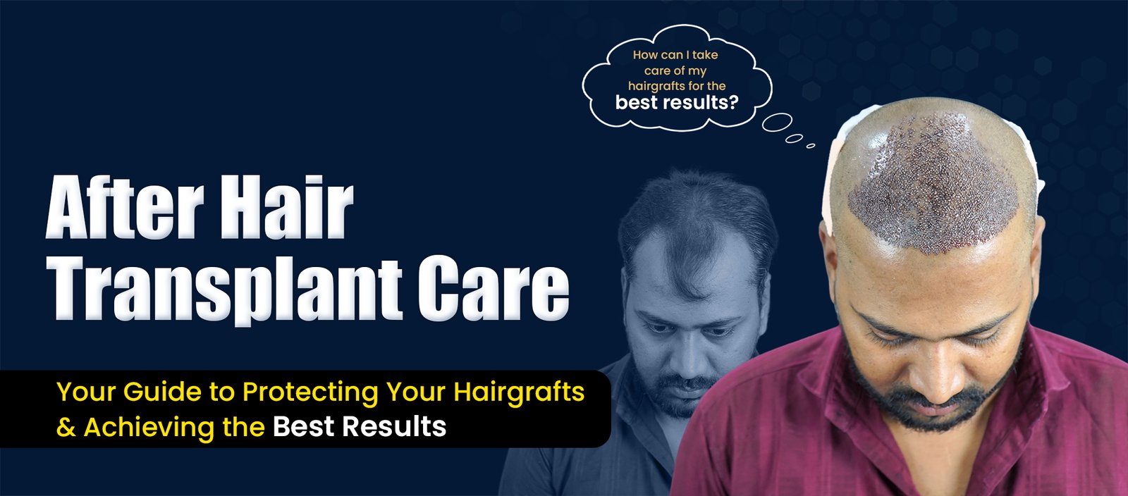 after hair transplant