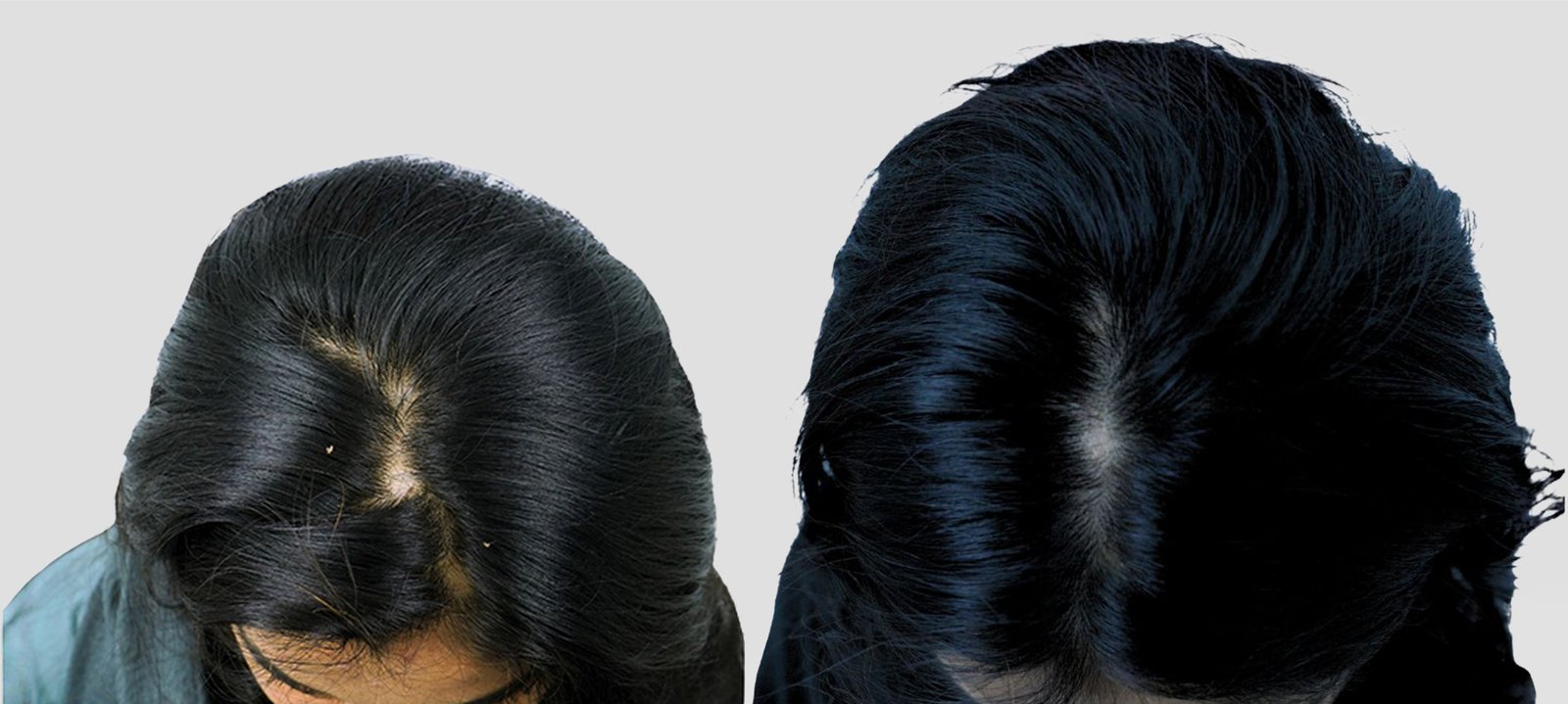 ATIYA SHAIKH Alopecia
