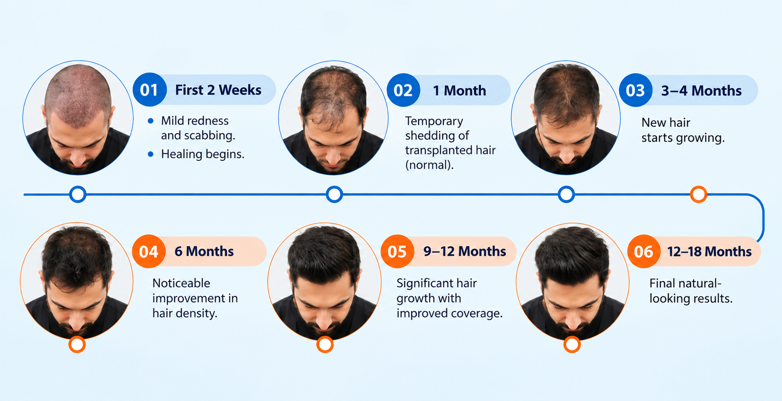 Male Hair Transplant in Pimple Gurav Best Male Hair Transplant Clinic in Pune Hair Transplant Surgeon in Pimple Gurav Hair Restoration Clinic in Pimple Gurav Male Hair Transplant Cost in Pune